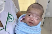 Trẻ bú kém, quấy khóc không ngờ uốn ván sơ sinh nguy kịch