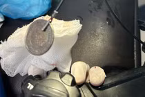 Trẻ 11 tuổi đau nghẹn vùng cổ, bác sĩ phát hiện đồng xu 3 cm nằm ở thực quản