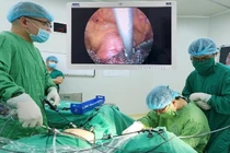 Đính lưới nhân tạo hiệu quả điều trị sa sinh dục tới 30 năm