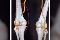 Người đàn ông Phú Thọ hồi sinh chân trái sau chấn thương đứt mạch máu khoeo