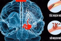 Địa chỉ vàng: Bệnh viện cấp cứu bệnh nhân đột quỵ tại Hà Nội