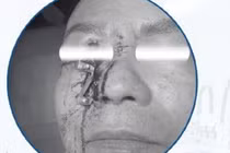 Loại bỏ dị vật kim loại lớn đâm xuyên vùng hốc mắt