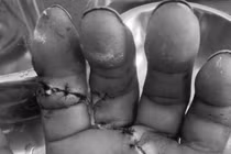 Vi phẫu nối chi thể đứt rời cứu bàn tay tổn thương phức tạp