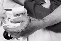 Sử dụng cưa máy, người đàn ông bị lưỡi cưa cắt gãy xương, đứt gân