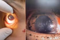 Nhiều ca chấn thương mắt nghiêm trọng do pháo nổ Tết 2026