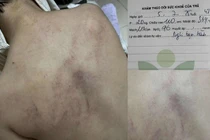 Bộ Y tế thông tin vụ nghi trẻ 4 tuổi bị bạo hành