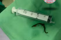 Cấp cứu thành công bệnh nhân 48 tuổi mắc dị vật thực quản dài 12 cm