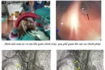 Hiếm gặp, ho ra máu ồ ạt từ nhánh lớn của động mạch vú