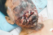 Mua pháo về đốt, trẻ 13 tuổi bị bỏng mặt nặng, mất thị lực 