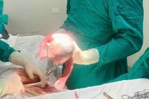 Sản phụ 20 tuổi mang thai lần 4 phải cắt tử cung vì viêm phúc mạc ruột thừa