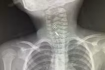 Gắp thành công kẹp tóc trong thực quản bé 5 tuổi ở Phú Thọ 