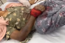 Bị rắn độc cắn, người phụ nữ nguy kịch tính mạng