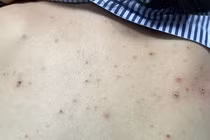 Cứu sống bệnh nhân 46 tuổi mắc thủy đậu biến chứng nặng tại Tây Ninh