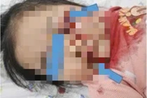 Cấp cứu bé gái hơn 2 tuổi bị chấn thương nặng do vô tình vặn tay ga xe máy