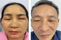 Cẩn thận virus Zona tái hoạt ở dây thần kinh mặt gây liệt