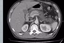 Cứu sống người đàn ông có men tụy, mỡ máu tăng cao gấp 12 lần cho phép