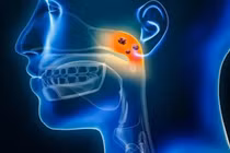 'Thủ phạm' âm thầm dẫn tới ung thư vòm họng