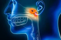 'Thủ phạm' âm thầm dẫn tới ung thư vòm họng