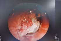 Gắp thành công dị vật mắc kẹt trong phổi thiếu niên 15 tuổi