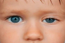 Khắc phục sụp mi mắt sau mổ tuyến giáp