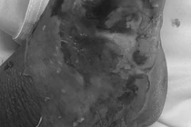 Chủ quan rắn cắn, nhập viện cấp cứu vì vết thương nhiễm trùng