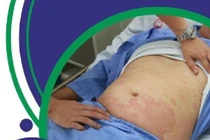 Sốc phản vệ độ 2 sau khi ăn cơm với cá thu