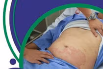 Sốc phản vệ độ 2 sau khi ăn cơm với cá thu