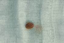 Bé 9 tuổi đau quặn thận do sỏi niệu quản