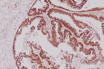 Ung thư đồng phát ở dạ dày - đại tràng, dấu hiệu ít ngờ tới