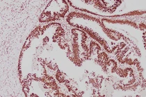 Ung thư đồng phát ở dạ dày - đại tràng, dấu hiệu ít ngờ tới