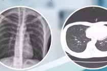 Trẻ khỏe mạnh tràn khí màng phổi mức độ nặng do vỡ kén khí