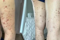 Cảnh giác với tổn thương da dai dẳng, nguy cơ bệnh hiếm