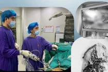 Đau bụng sau chấn thương kín, người đàn ông vỡ lách nguy kịch