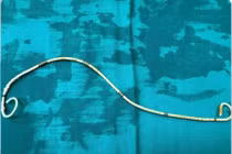 Sỏi bám dày đặc quanh ống sonde JJ bị bỏ quên 3 năm