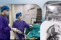 Đau bụng sau chấn thương kín, người đàn ông vỡ lách nguy kịch