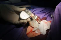 Những điều cần biết để sống khỏe sau khi đặt máy tạo nhịp tim