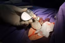 Những điều cần biết để sống khỏe sau khi đặt máy tạo nhịp tim