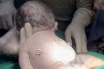 Can thiệp bào thai, em bé ra đời khỏe mạnh với 'đôi cánh nhỏ' trên lưng