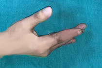 Lần đầu tiên tại Việt Nam, vi phẫu cứu sống ngón tay đứt rời sau 25 giờ