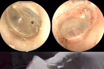 Phát hiện bọ chó sống trong tai người phụ nữ 60 tuổi