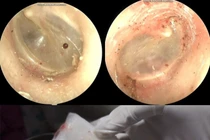 Phát hiện bọ chó sống trong tai người phụ nữ 60 tuổi