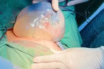 Hiếm gặp song sinh chung buồng ối, một bé “đẻ bọc điều” 