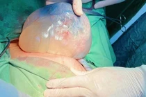 Hiếm gặp song sinh chung buồng ối, một bé “đẻ bọc điều” 