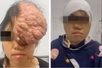 Người phụ nữ có khối u sụn xương sọ kích thước khổng lồ