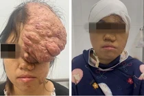 Người phụ nữ có khối u sụn xương sọ kích thước khổng lồ
