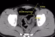 Cấp cứu thành công ca thủng đại tràng do bị vòi rửa xe xịt vào hậu môn
