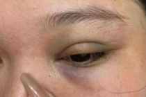 Người phụ nữ ở Hà Nội tố bị thanh niên lạ đánh gãy xương hốc mắt