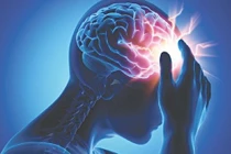 Nguy cơ tái phát đột quỵ do rung nhĩ ở mức đáng báo động