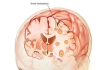 Các loại ung thư dễ di căn não