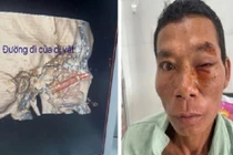 Cây chọc vào hốc mắt, nguy cơ mất thị lực vĩnh viễn